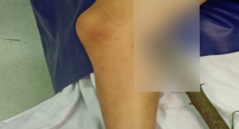 Bé trai 11 tuổi bị cành cây đâm xuyên đùi