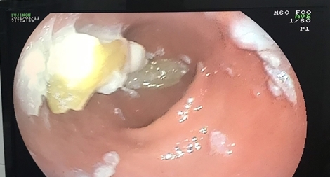 Nuốt 4 chiếc răng giả vào bụng trong lúc ăn cơm