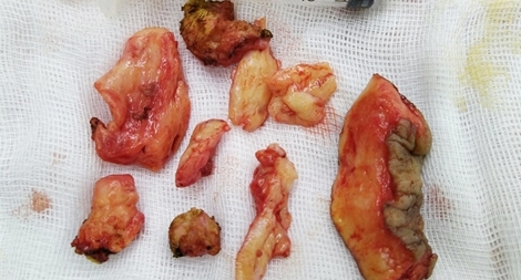 Suýt mất "của quý" do bơm silicon tăng kích thước