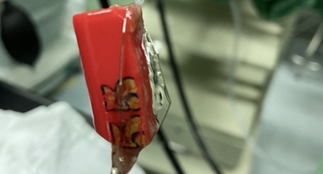 Lấy bật lửa ra khỏi dạ dày bệnh nhân  