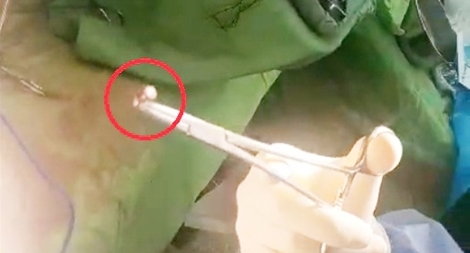 Thông tin mới nhất vụ bị bắn thủng bụng lúc 2 giờ sáng