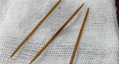 Ngậm tăm nằm ngủ, tỉnh dậy phải nhập viện