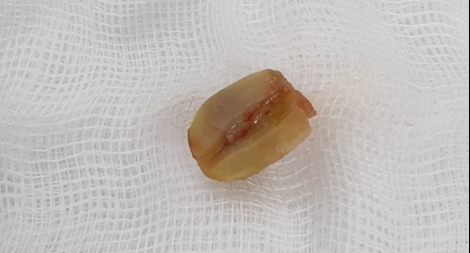 "Gắp" hạt đậu phộng trong phổi cụ ông 95 tuổi