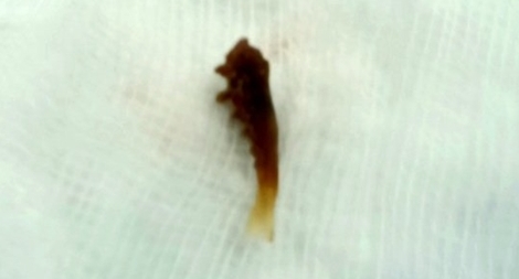 Người phụ nữ bị xương cá găm chặt trong phế quản suốt 1 năm  