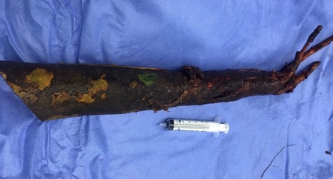 Cứu sống bệnh nhân bị cọc gần 1 mét đâm xuyên hạ vị