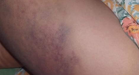 Học sinh lớp 3 bị cô giáo đánh bầm tím đùi vì không học bài