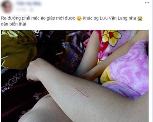 Hai thiếu nữ bịa chuyện bị kẻ gian rạch “tay, chân” để “câu like”