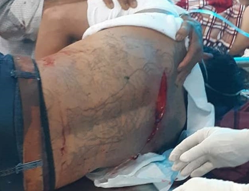 Mâu thuẫn tiền bạc, mang dao chém con nợ trọng thương