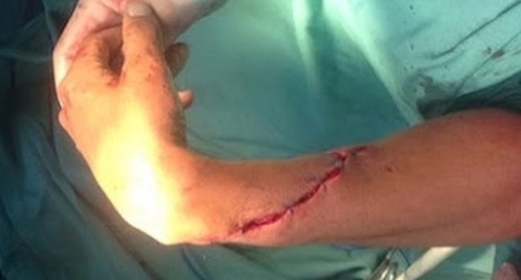 Bắt 2 thanh niên chém người đứt lìa bàn tay