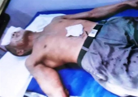 Tạm giữ nghi phạm tạt axit làm 2 người bị bỏng ở Thái Bình